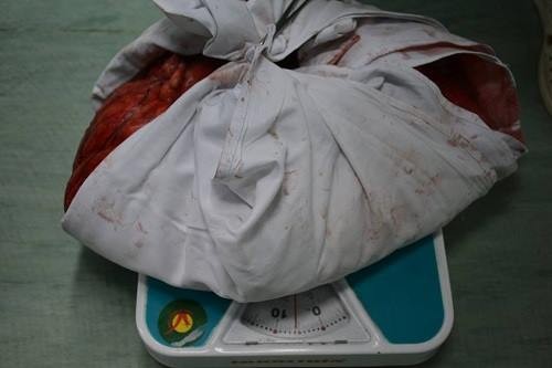 Người đàn ông 56 tuổi mang khối u nặng 6kg trong người - ảnh 1