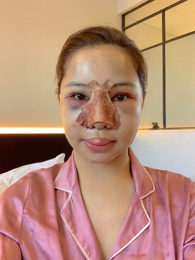 Lưu Đê Ly tung ảnh phẫu thuật biến dạng, công khai 'đập mặt' níu kéo tuổi xuân - ảnh 2