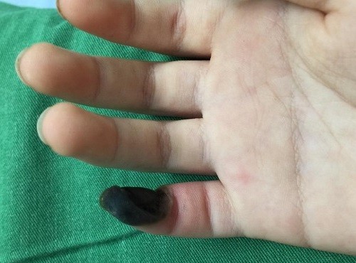 Bé 6 tuổi bị hoại tử ngón tay khi bôi thuốc trị mụn cóc mua trên mạng - ảnh 1