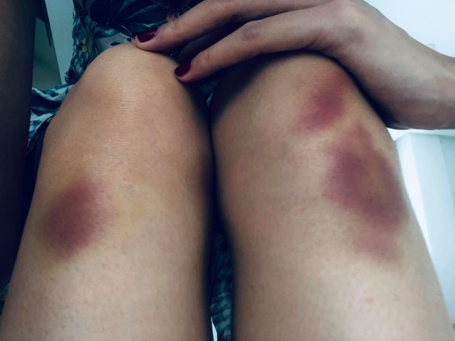 Thủy Tiên ngã chấn thương lưng khi tập vũ đạo trên không - ảnh 1