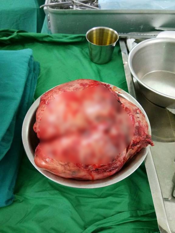 Thường xuyên ói sau ăn, bệnh nhân suýt chết vì khối u 2,5 kg - ảnh 2
