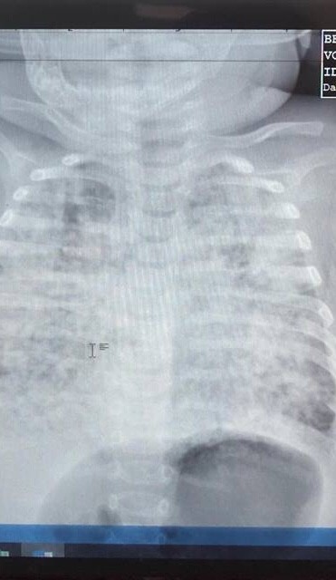 Bé trai 5 tháng tuổi phổi trắng xóa vì nhiễm lao từ cha - ảnh 1