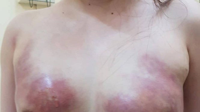 Bơm mỡ nhân tạo tại Spa, cô gái 24 tuổi bị cắt bỏ một bên ngực - ảnh 1