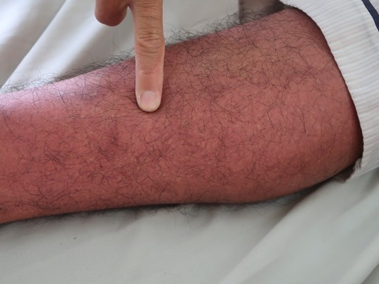 Dịch sốt xuất huyết tại TPHCM vẫn cao dù đang ở chu kỳ giảm - ảnh 2
