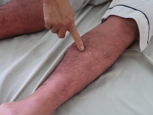 Dịch sốt xuất huyết tại TPHCM vẫn cao dù đang ở chu kỳ giảm - ảnh 3