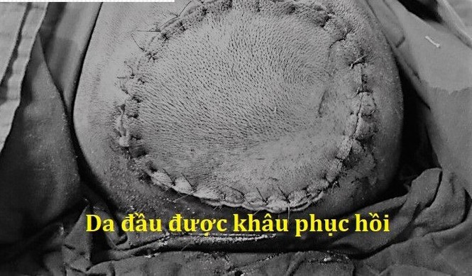 Bé gái bị tróc da đầu vì tóc cuộn vào máy xay tiêu - ảnh 3