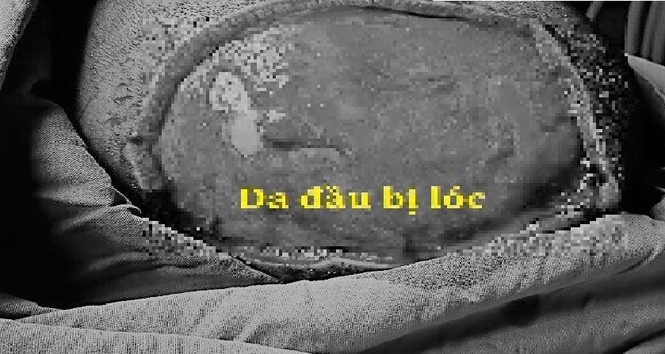 Bé gái bị tróc da đầu vì tóc cuộn vào máy xay tiêu - ảnh 2