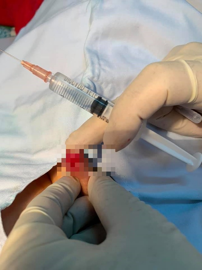 Giỡn với bạn gái, bé trai lớp hai bị đá rách toạc “của quý” - ảnh 2