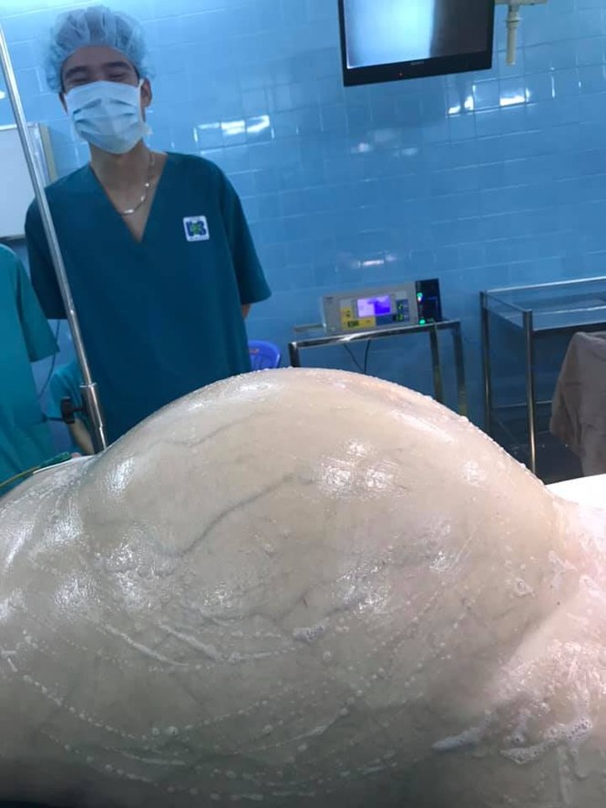 Choáng với khối u khủng nặng 25 kg trong ổ bụng bệnh nhân - ảnh 1