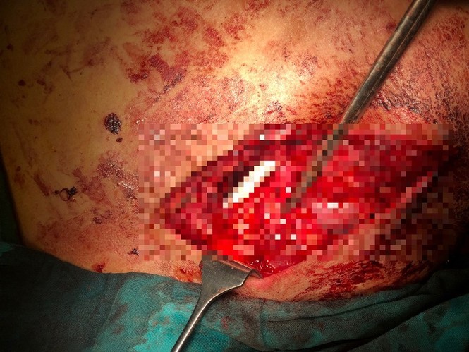 Bị máy trộn bê tông quấn giựt, nam thanh niên suýt phải tháo khớp vai - ảnh 2