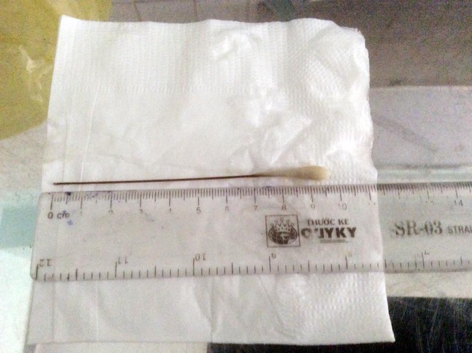 Gắp thành công “tăm tre tự chế” dài gần 10 cm ra khỏi phổi cụ ông - ảnh 1