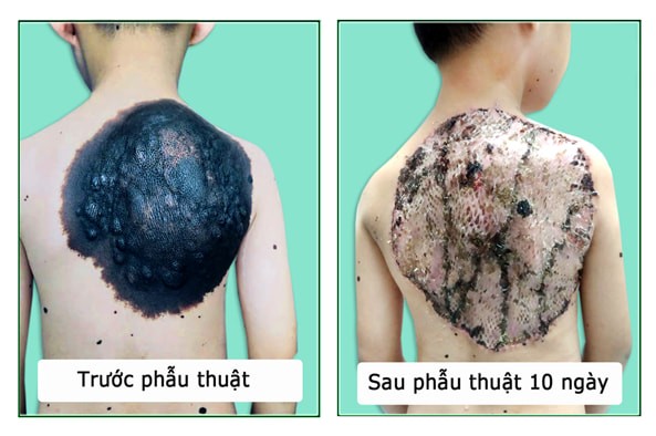 Phẫu thuật thành công “mai rùa” trên lưng bé trai 7 tuổi - ảnh 1