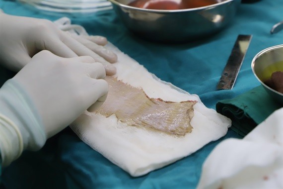 Bệnh viện Sài Gòn cứu cô gái bị liên cầu khuẩn lợn do xước tay - ảnh 1 Bệnh viện Sài Gòn cứu cô gái bị liên cầu khuẩn lợn do xước tay - ảnh 1