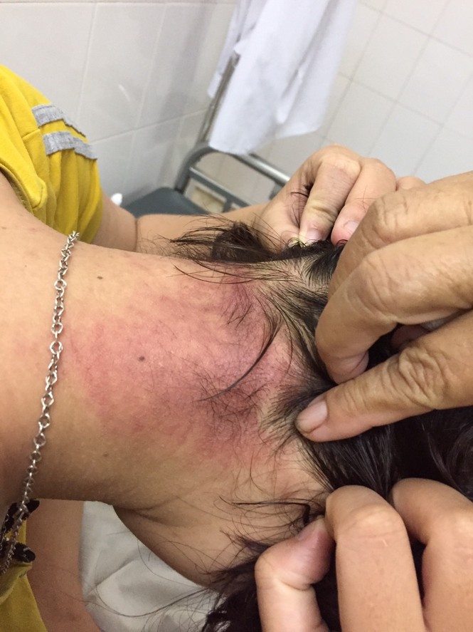 Nằm viện, nhiều bệnh nhân thành nạn nhân của kiến ba khoang - ảnh 1
