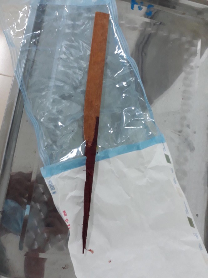 Lấy thành công mảnh gỗ nửa mét “đi lạc” vào ngực người thợ mộc - ảnh 2