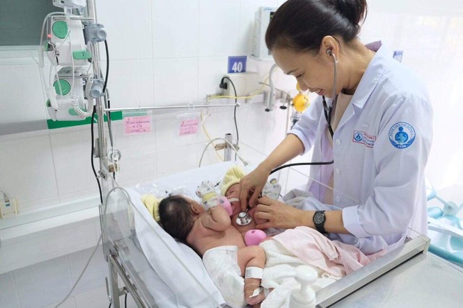 Mổ tách đôi bé song sinh dính liền phần gan - ảnh 1