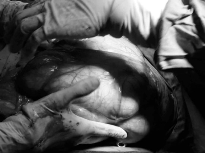 Người phụ nữ mang khối u hơn 6kg trong bụng nhưng không hay biết - ảnh 1