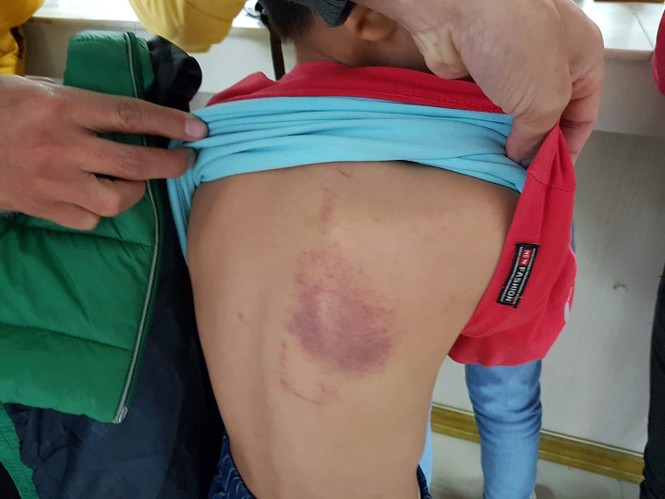 Đánh học sinh bầm tím, cô giáo vội vã gọi điện xin lỗi phụ huynh - ảnh 1