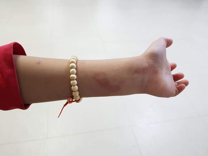 Đánh học sinh bầm tím, cô giáo vội vã gọi điện xin lỗi phụ huynh - ảnh 2