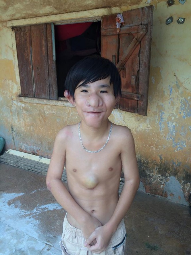 Cậu bé “Trư Bát Giới” và gần chục lần lên bàn mổ - ảnh 1