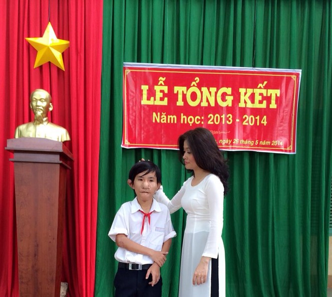 Cậu bé “Trư Bát Giới” và gần chục lần lên bàn mổ - ảnh 3