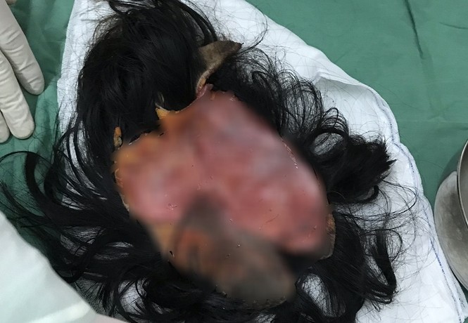 Nữ bệnh nhân kể lại giây phút kinh hoàng bị máy xay xát lóc da đầu - ảnh 2 Nữ bệnh nhân kể lại giây phút kinh hoàng bị máy xay xát lóc da đầu - ảnh 2