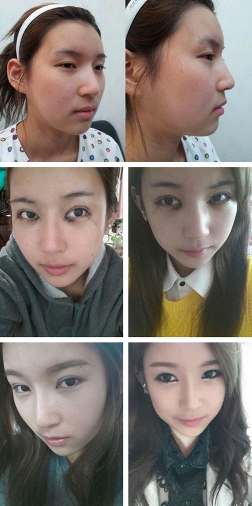 Dù biết sẽ có những biến chứng nhất định nếu quá lạm dụng nhưng ước mơ đổi đời đã thúc đẩy các cô gái ở Hàn Quốc đi phẫu thuật thẩm mỹ. Trào lưu dao kéo ở những người nổi tiếng có tác động không nhỏ tới xu hướng phẫu thuật thẩm mỹ ở xứ kim chi hiện nay