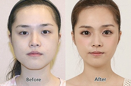Cắt mí mắt, gọt hàm là những thủ thuật cô gái này thực hiện để trở nên xinh đẹp hơn