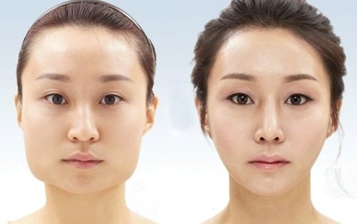 Gọt hàm và cằm để tạo thành gương mặt chữ V thon thả là mốt đang rất được yêu thích tại các nước châu Á, trong đó có Việt Nam