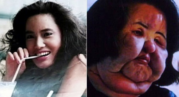 Nữ người mẫu Hàn Quốc Hang Mioku khiến nhiều người không khỏi bàng hoàng vì gương mặt biến đổi quá nhiều. Từ một người mẫu xinh đẹp, Mioku bắt đầu tìm đến phẫu thuật thẩm mỹ năm 28 tuổi. Trải qua nhiều cuộc phẫu thuật ở Nhật, gương mặt cô bắt đầu xuất hiện di chứng: biến dạng, phù nề và xấu xí đi rất nhiều. Không dừng lại ở đó, để thỏa mãn cơn nghiện thẩm mỹ nhưng không đủ sức mua thêm silicon , cô dùng cả dầu ăn để thay thế. Bác sĩ đã lấy ra từ gương mặt cô 60 gram chất lạ và 200 gram từ cổ của cô Mioku. Cô còn được xếp vị trí đầu tiên trong những