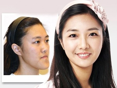 Chiếc cằm thô, bè khiến gương mặt có tạo hình lưỡi cày xấu xí, nhưng khi chỉnh lại, tổng thể trở nên hài hòa, cân đối