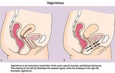 Mắc kẹt khi 'yêu', lời đồn hay sự thực? - ảnh 1