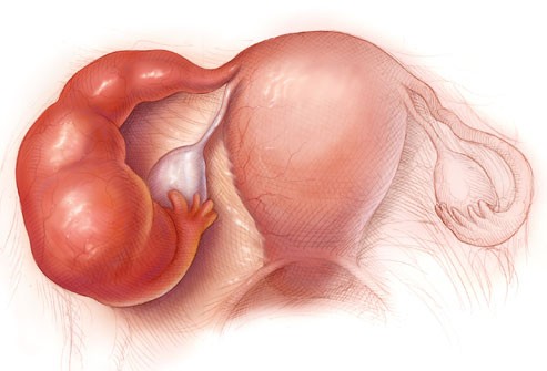 Những nguyên nhân hàng đầu gây đau bụng dưới ở phụ nữ - ảnh 2