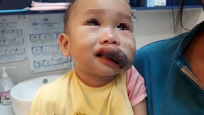 Phẫu thuật từ thiện cho các bệnh nhi khó khăn, mắc dị dạng hiếm gặp - ảnh 2