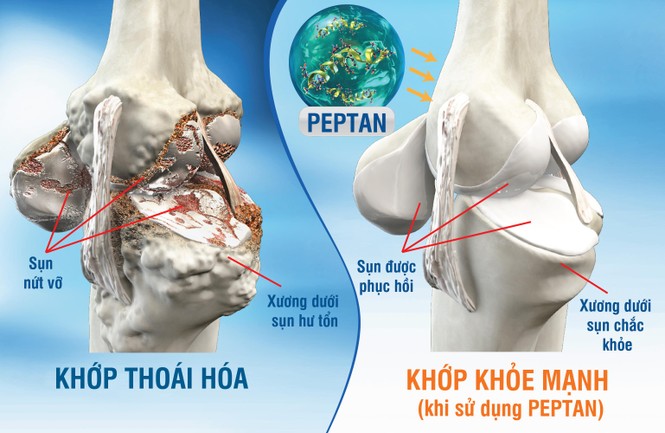 Đau nhức xương khớp mùa mưa lạnh: Chủ quan dễ gây tàn phế! - ảnh 1