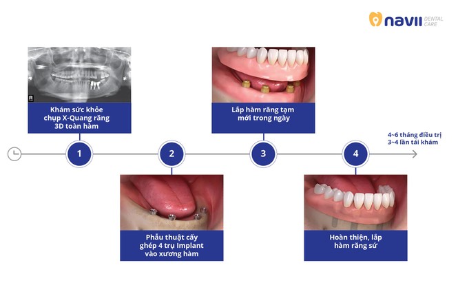 Implant ALL On 4 – Giải pháp an toàn tiết kiệm cho người bị mất răng toàn hàm - ảnh 3