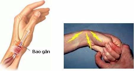 Ai dễ bị viêm điểm bám gân?