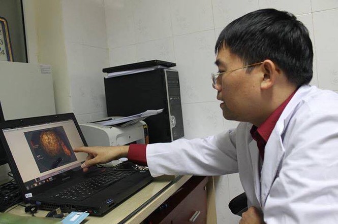 4 khối u to như quả trứng trong dạ dày vì ăn hồng giòn - ảnh 2