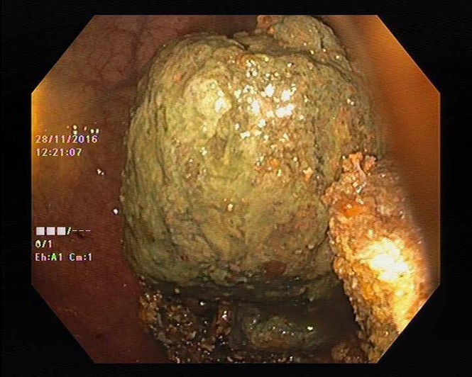 4 khối u to như quả trứng trong dạ dày vì ăn hồng giòn - ảnh 1