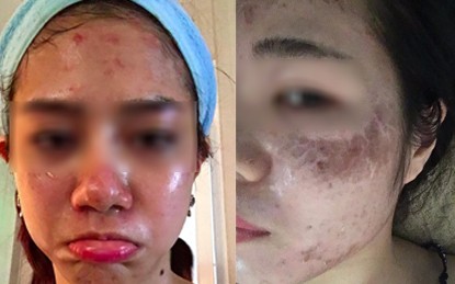 Đau đớn ê chề vì trót lăn kim làm đẹp da mặt - ảnh 1