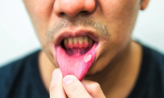 Cảnh báo: Phát hiện thủ phạm mới gây ung thư miệng - ảnh 2 Cảnh báo: Phát hiện thủ phạm mới gây ung thư miệng - ảnh 2