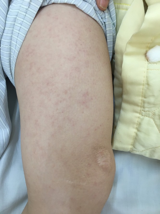 Bay từ TP. HCM ra, thanh niên Hà Nội nguy kịch vì sởi biến chứng - ảnh 1