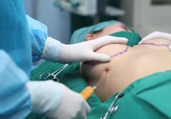 Chị em nên biết sự thật này trước khi đi 'nâng cấp vòng 1' - ảnh 2