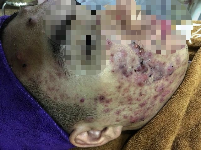 Quý bà Hà Nội mặt 'nát nhừ' vì lăn kim làm đẹp, tẩy trắng da - ảnh 1