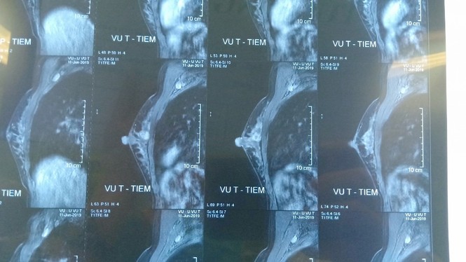 Gái chưa chồng bàng hoàng bị cắt hết 'nhũ hoa' vì căn bệnh này - ảnh 1