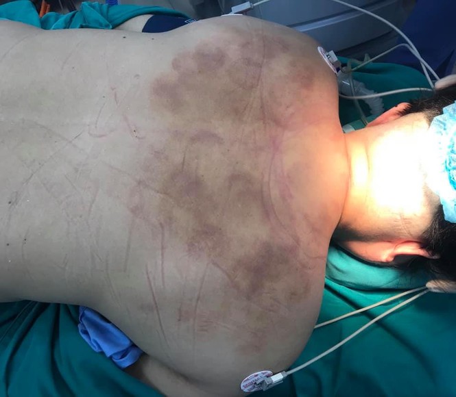 Liệt cả người vì chữa thoát vị đĩa đệm bằng... giác hơi - ảnh 1