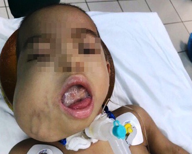 Giáo sư Mỹ đến Huế giúp mổ khối u quái hiếm gặp tại vùng mặt cháu bé 4 tuổi - ảnh 1
