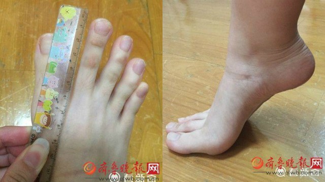 Nữ sinh bất ngờ nổi tiếng vì 'ngón chân dài... như ngón tay' - ảnh 1