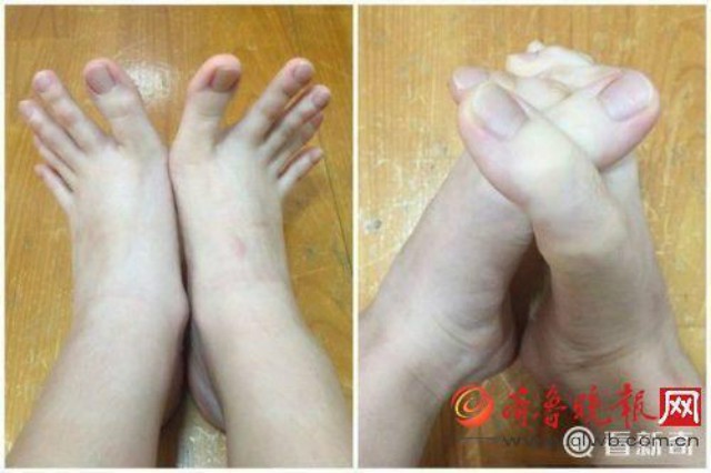 Nữ sinh bất ngờ nổi tiếng vì 'ngón chân dài... như ngón tay' - ảnh 2