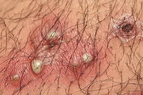 Mùa mưa, cẩn trọng với bệnh về da - ảnh 2